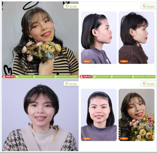 THÁO MẮC CÀI NIỀNG RĂNG THÔI - TẠM BIỆT RĂNG HÔ