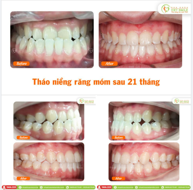 THÁO NIỀNG RĂNG MÓM, KHỚP CẮN NGƯỢC SAU 21 THÁNG