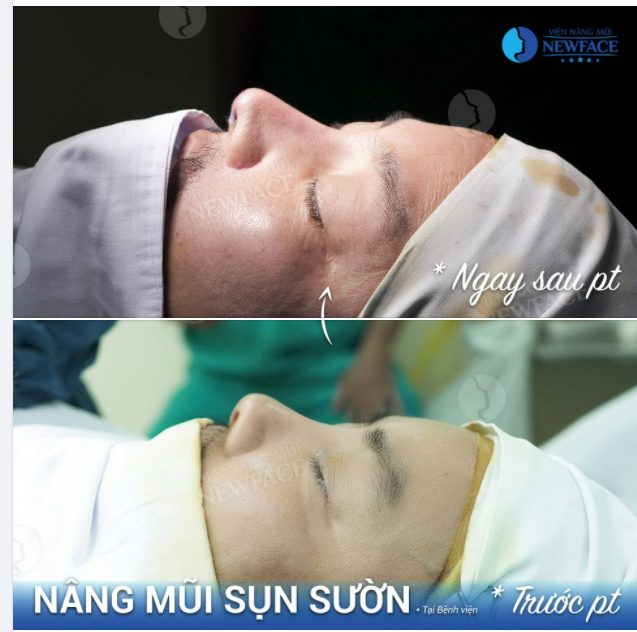 THAY ĐỔI KINH NGẠC SAU NÂNG MŨI SỤN SƯỜN