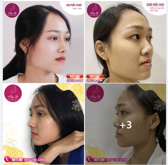 THÊM 1 COMBO MẮT ĐẸP - MŨI XINH, TỰ TIN KHOE SẮC
