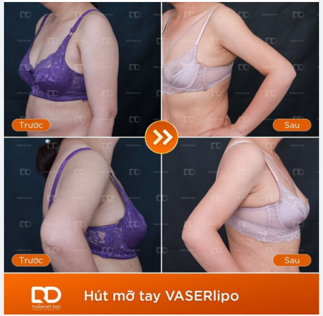 Thon gọn bắp tay, tư tin diện đồ khoe dáng sau Hút mỡ bắp tay VASERlipo.