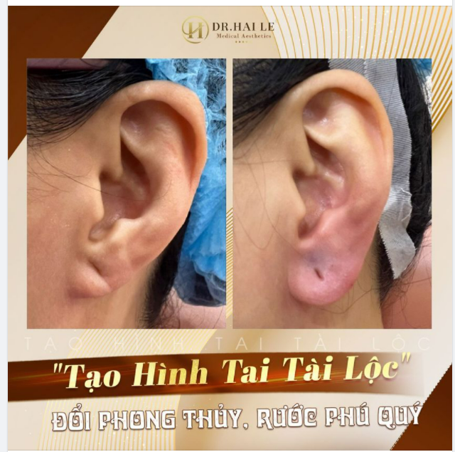 TIÊM FILLER TẠO HÌNH TAI TÀI LỘC - Đổi phong thủy, rước phú quý