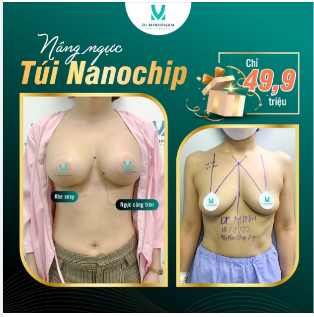 Tìm đâu được nơi Tiến sĩ thẩm mỹ thực hiện, túi ngực NanoChip cao cấp, làm tại bệnh viện vô khuẩn mà lại có giá chỉ 49,9Tr