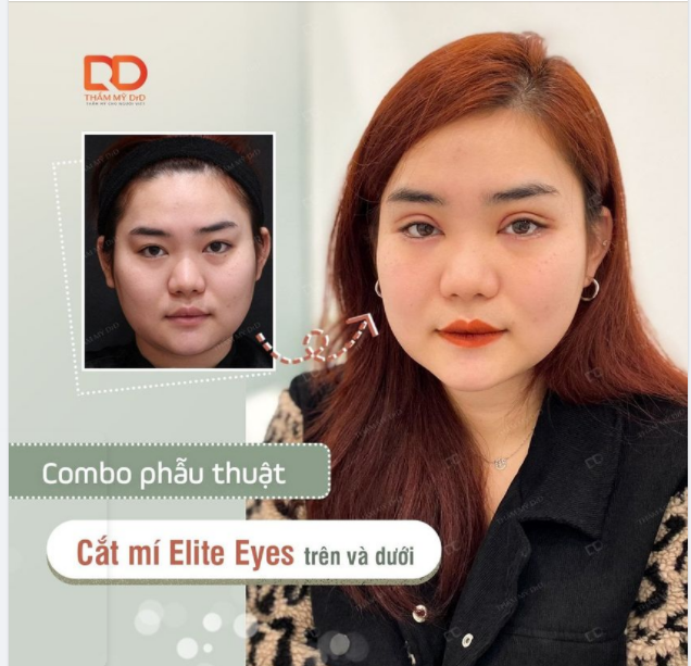 Tìm đâu một chiếc combo Cắt mí xuất sắc như thế này nhưng vì sợ đau gấp đôi nên ngần ngại.