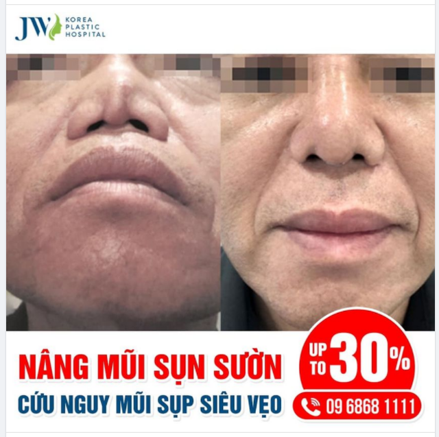 TÌM LẠI VẺ NGOÀI HOÀN THIỆN TỪ VIỆC BẺ CONG CHIẾC MŨI SIÊU SỤP