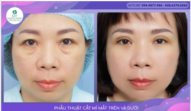 Trao lại nét thanh xuân qua đôi mắt