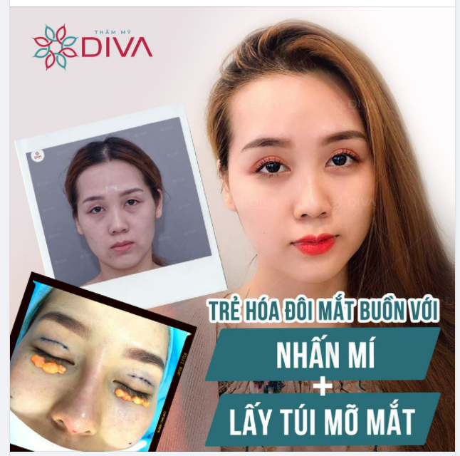 TRẺ HÓA ĐÔI MẮT BUỒN VỚI NHẤN MÍ + LẤY TÚI MỠ MÍ DƯỚI