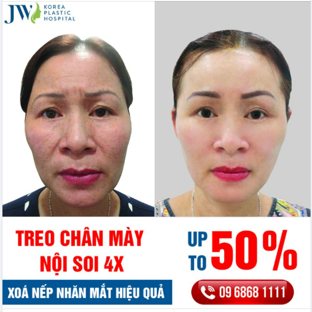 TREO CHÂN MÀY NỘI SOI 4X TẤM VÉ LẤY LẠI ĐÔI MẮT KHÔNG NẾP NHĂN
