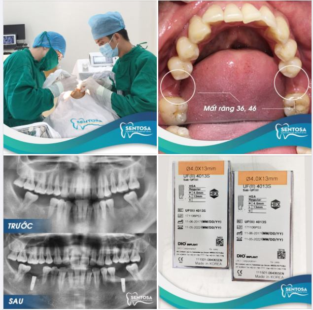 TRỒNG 2 RĂNG IMPLANT MÀ VÔ CÙNG NHẸ NHÀNG NHANH GỌN