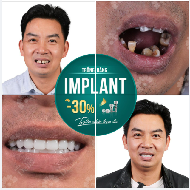 Trồng răng implant All- on - Phục hồi mất răng toàn hàm hiệu quả trọn đời!