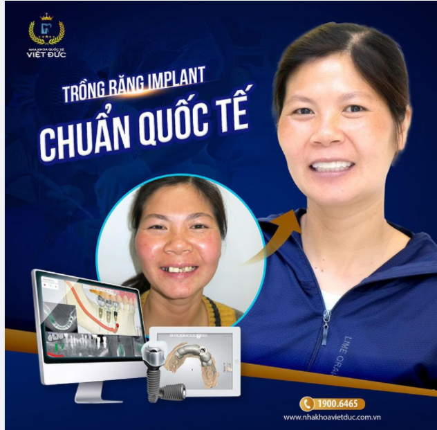 TRỒNG RĂNG IMPLANT CHUẨN QUỐC TẾ