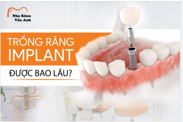 TRỒNG RĂNG IMPLANT ĐƯỢC BAO LÂU
