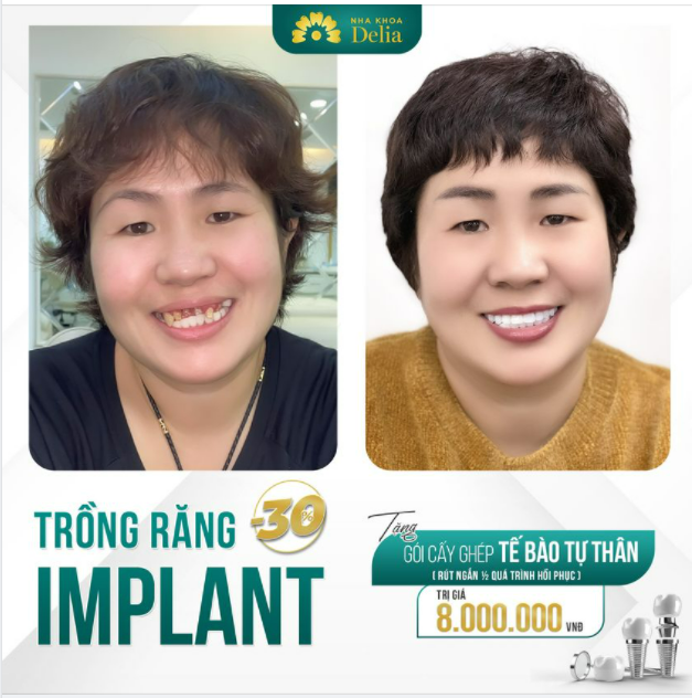 TRỒNG RĂNG IMPLANT - Giải cứu răng gãy, hỏng do bọc sứ kém chất lượng