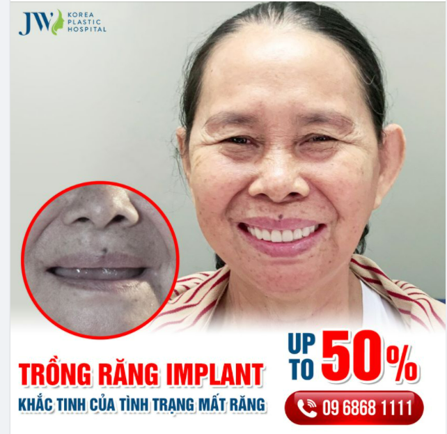 TRỒNG RĂNG IMPLANT KHẮC TINH CỦA TÌNH TRẠNG MẤT RĂNG