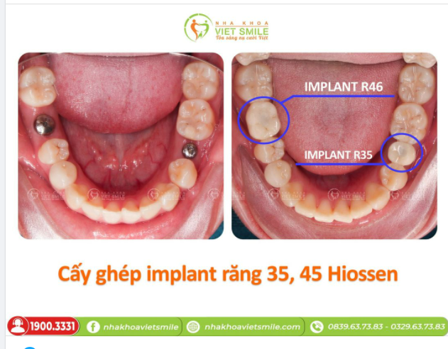 TRỒNG RĂNG IMPLANT RĂNG 35, 46 - LẤY LẠI CẢM GIÁC ĂN NHAI