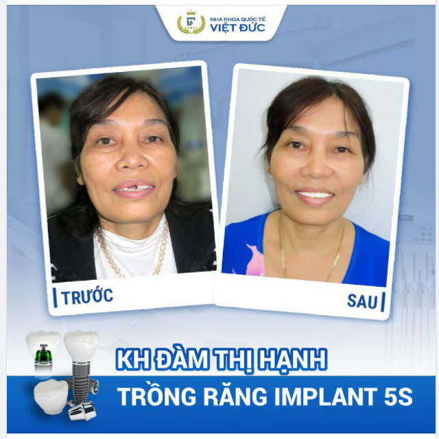 “TRƯỚC NGHĨ TRỒNG RĂNG SỢ LẮM MÀ HÓA RA KHÔNG ĐAU TẸO NÀO. GIỜ TÔI CÓ THỂ ĂN UỐNG THOẢI MÁI, CŨNG TỰ TIN HƠN KHI CƯỜI”