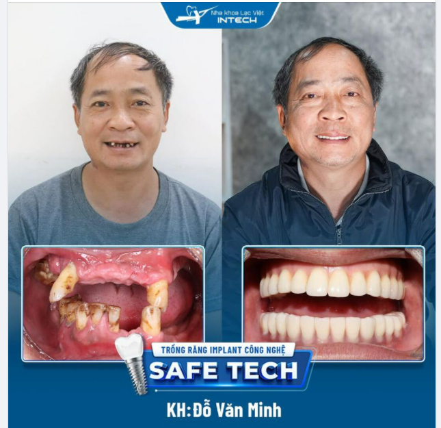 TỪ GIỜ ĐẾN GIÀ CHÚ KHÔNG CÒN LO ĐAU RĂNG NỮA RỒI…