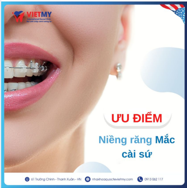 ƯU ĐIỂM NIỀNG RĂNG MẮC CÀI SỨ