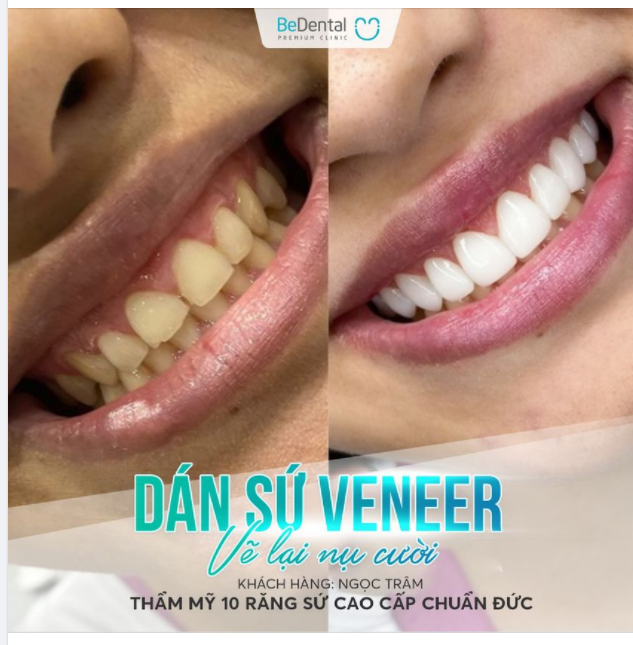 Vẽ lại nụ cười nhờ dán sứ veneer