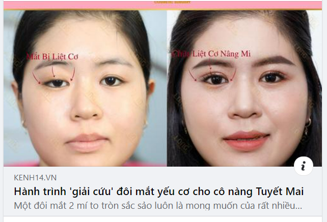 VÌ SAO MẮT 2 MÍ TRỞ THÀNH TRÀO LƯU HOT NHẤT HIỆN NAY
