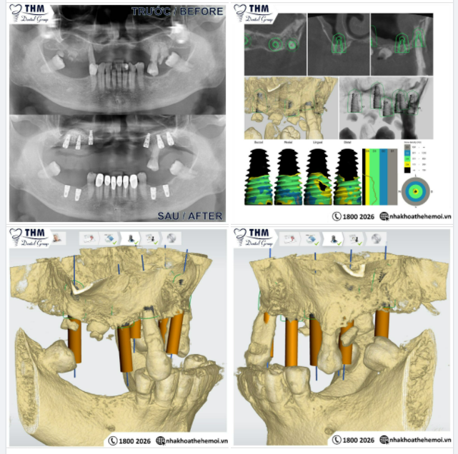 VÌ SAO NÊN CẤY GHÉP IMPLANT KHI MẤT RĂNG