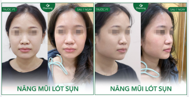 Việc nâng mũi tuy không phải phẫu thuật quá phức tạp nhưng lại có thể mang đến sự thay đổi rất lớn trên gương mặt.