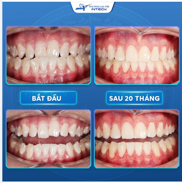 X-MATRIX – GIẢI QUYẾT HOÀN TOÀN RĂNG TRÌNH TRẠNG KHỚP CẮN NGƯỢC