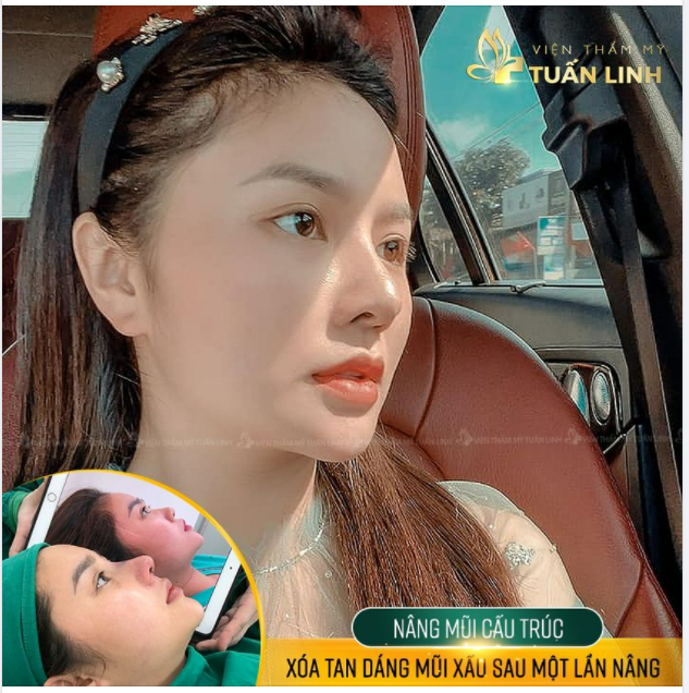 XÓA TAN DÁNG MŨI XẤU CHỈ SAU MỘT LẦN NÂNG.
