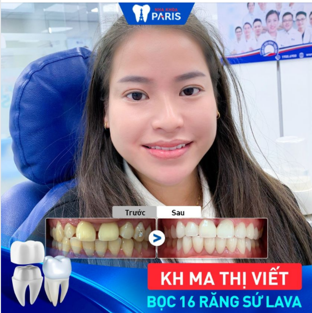 YÊU BẢN THÂN, CƯỜI ĐẸP TỰ TIN CÙNG HÀM RĂNG TRẮNG SÁNG