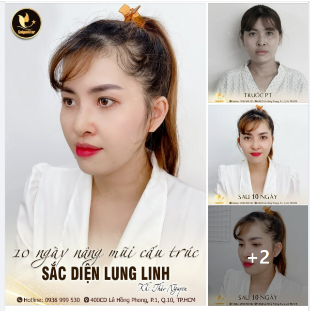 10 NGÀY NÂNG MŨI CẤU TRÚC SẮC DIỆN LUNG LINH
