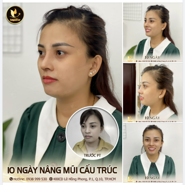 10 NGÀY NÂNG MŨI CẤU TRÚC