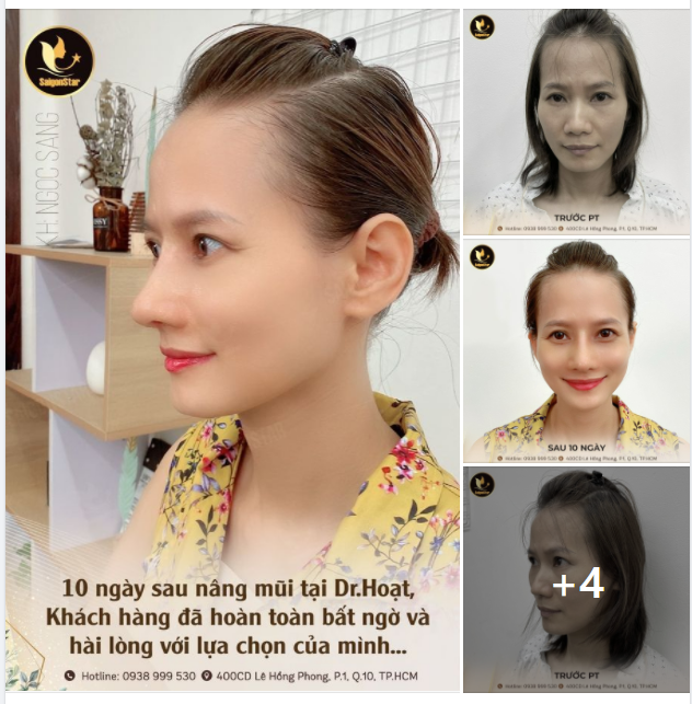 10 NGÀY SAU NÂNG MŨI TẠI DR.HOẠT KHÁCH HÀNG HOÀN TOÀN BẤT NGỜ VÀ HÀI LÒNG VỚI LỰA CHỌN CỦA MÌNH