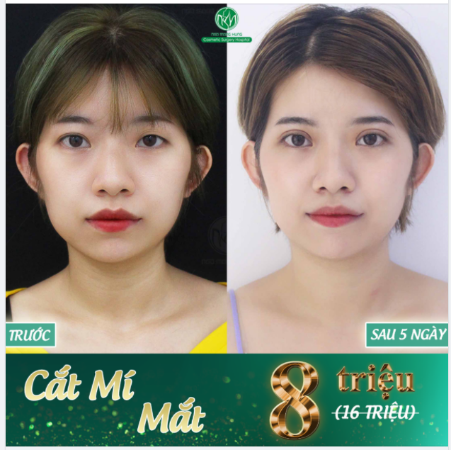 10 SUẤT CẮT MÍ MẮT CHỈ VỚI 8TRIỆU