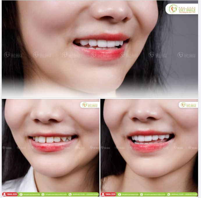 18R RĂNG SỨ NACERA THỦ CÔNG - ĐÓNG KHE THƯA, THẨM MỸ NỤ CƯỜI
