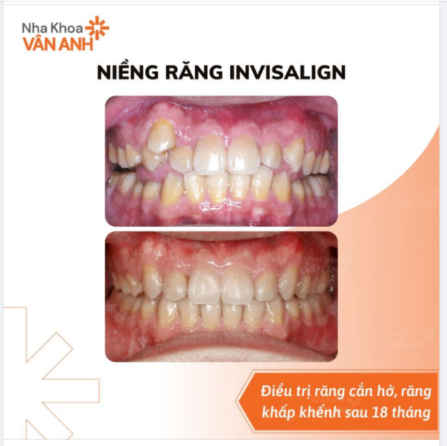27 TUỔI RĂNG LỢI NHƯ THẾ NÀY THÌ KHÔNG THỂ TỰ TIN NỔI
