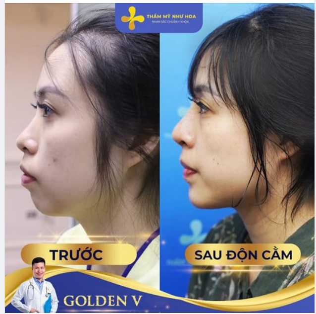 3 CÁCH PHỔ BIẾN GIÚP BẠN SỞ HỮU CẰM V-LINE THON GỌN, SANG CHẢNH