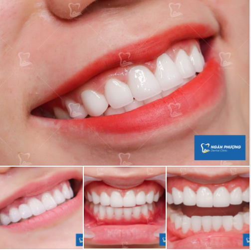 3 tiêu chí chọn màu răng sứ - kiến tạo nụ cười tự nhiên, hoàn hảo