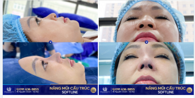 45 tuổi lần đầu tiên nâng mũi và cái kết.. Đẹp như mơ