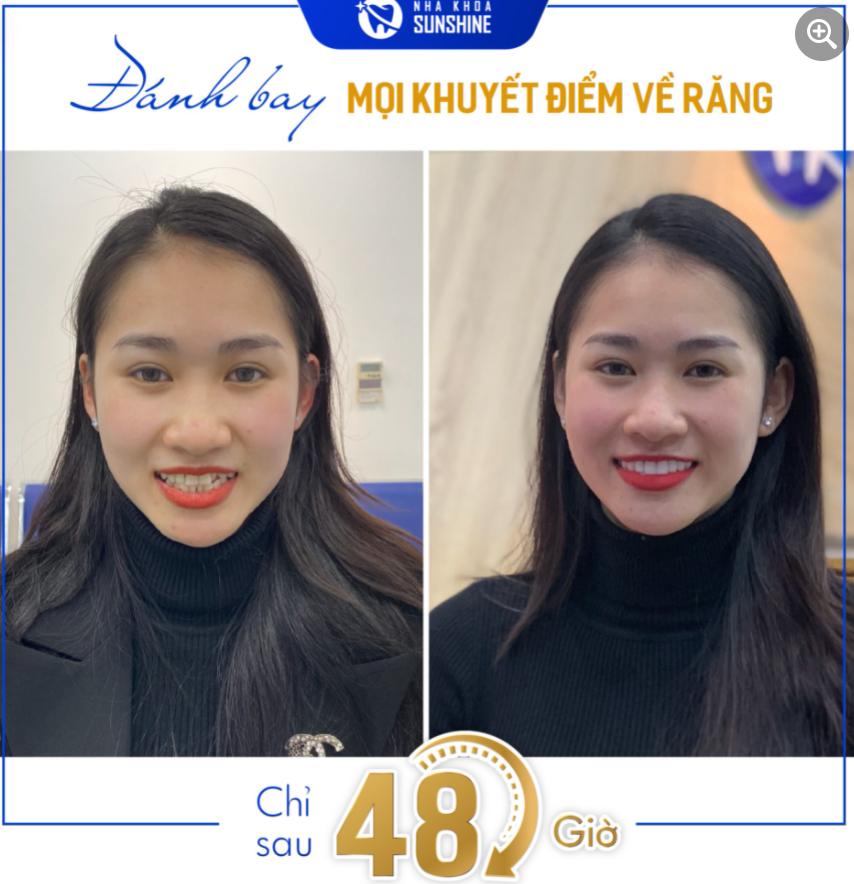 48H ĐÁNH BAY MỌI KHUYẾT ĐIỂM VỀ RĂNG