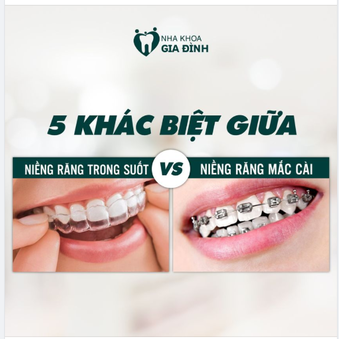 5 KHÁC BIỆT GIỮA NIỀNG RĂNG TRONG SUỐT VÀ MẮC CÀI