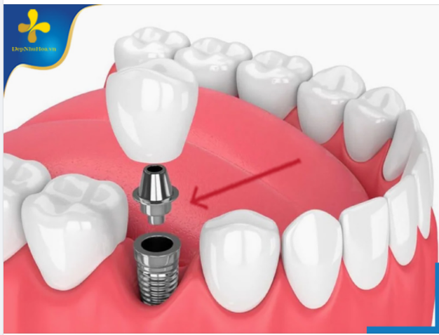 5 THÔNG TIN QUAN TRỌNG DÀNH CHO NGƯỜI CÓ Ý ĐỊNH CẤY GHÉP IMPLANT