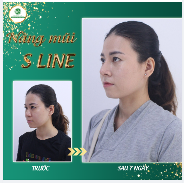 7 NGÀY CHO DÁNG MŨI ĐẸP TOÀN DIỆN