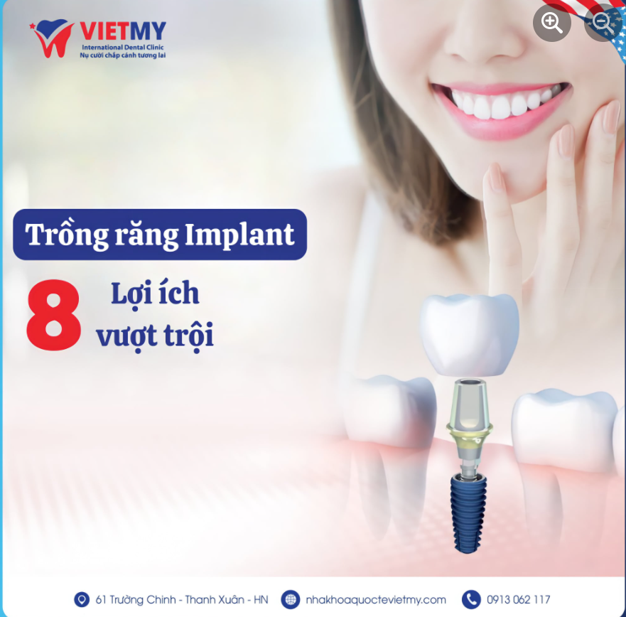 8 LỢI ÍCH VƯỢT TRỘI KHI TRỒNG RĂNG IMPLANT