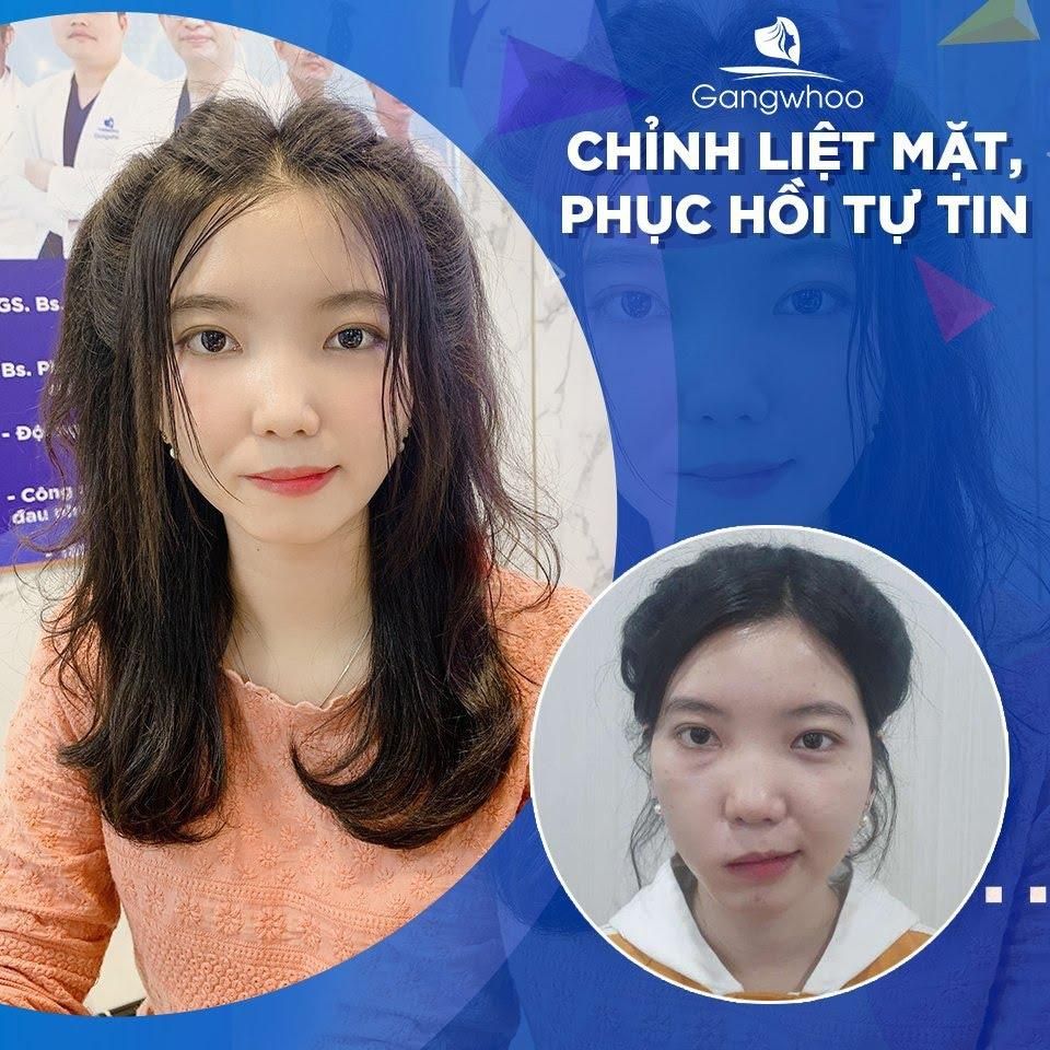 Thẩm Mỹ Viện Gangwhoo - Địa Chỉ Điều Trị Liệt Dây Thần Kinh Số 7 Uy Tín Tại TPHCM
