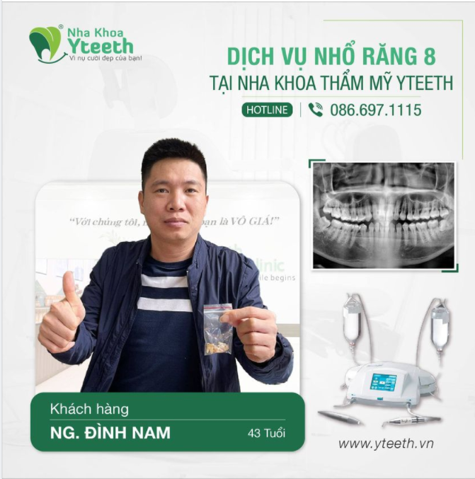 Anh Đình Nam 43 tuổi nhổ 1 lúc 3 chiếc răng khôn không hề sưng đau như lời đồn