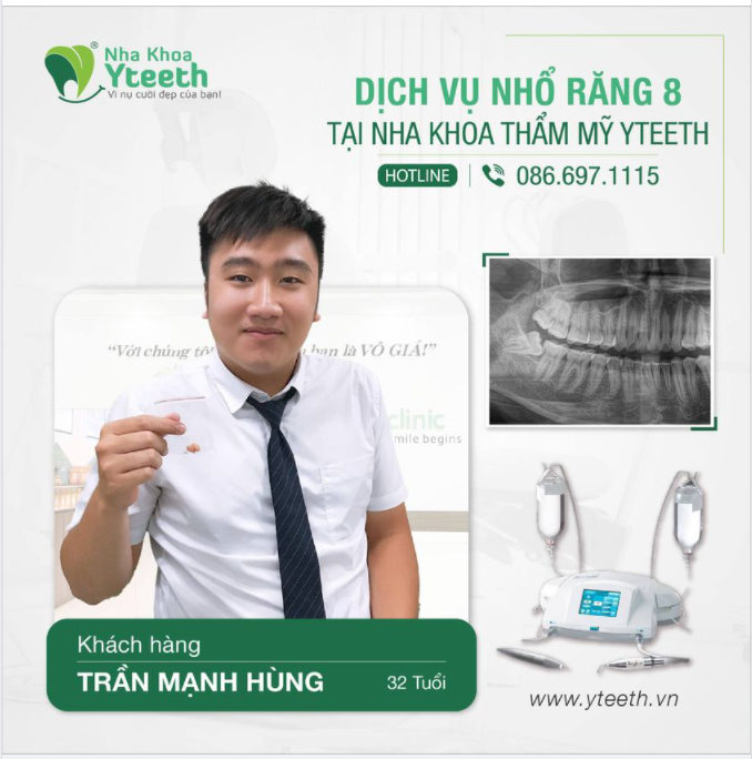 Anh Hùng 35 tuổi nhổ 1 răng số 8 hàm dưới mọc lệch đâm vào răng số 7 chỉ sau 5 phút cho 1 chiếc răng.