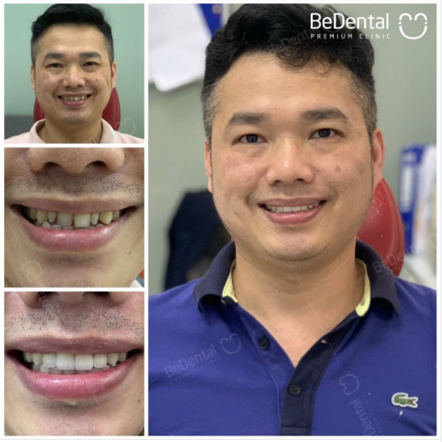 Anh Trung - Cải thiện khuyết điểm hàm răng với phục hình 5 răng sứ Lava
