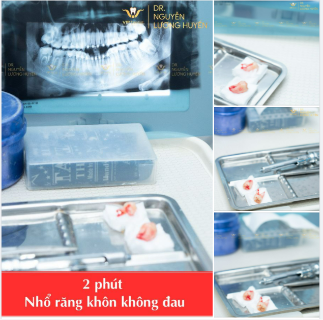 “Bác sĩ ơi! Trước khi niềng cháu có thể nhổ răng khôn trước được không”