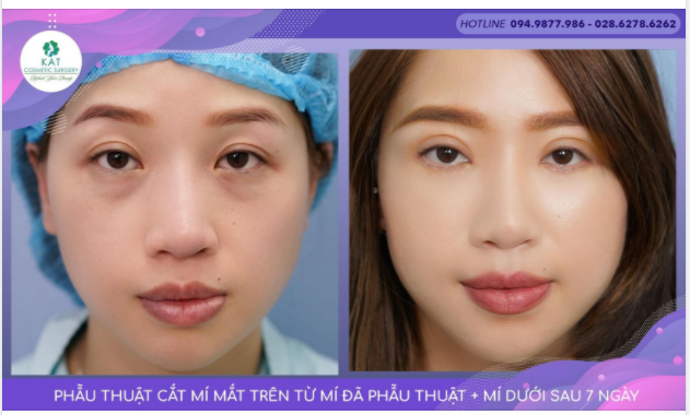 Bạn có thể trẻ hơn bao nhiêu tuổi sau combo phẫu thuật mí mắt trên và dưới