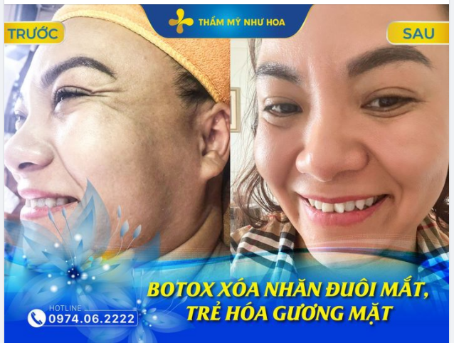 BẠN ĐÃ THỬ QUA 4 CÁCH XOÁ NẾP NHĂN HIỆU QUẢ QUANH KHOÉ MẮT CHƯA